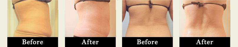 キャビテーションスリム